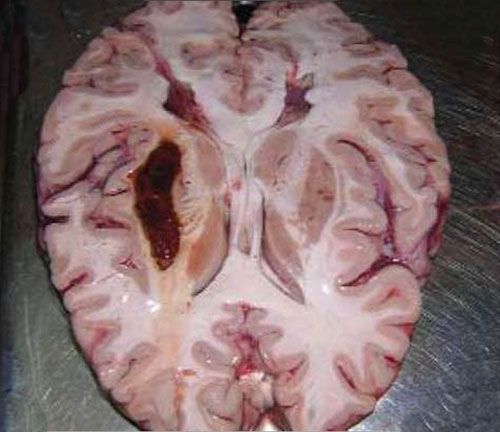 Лечение энцефалопатии